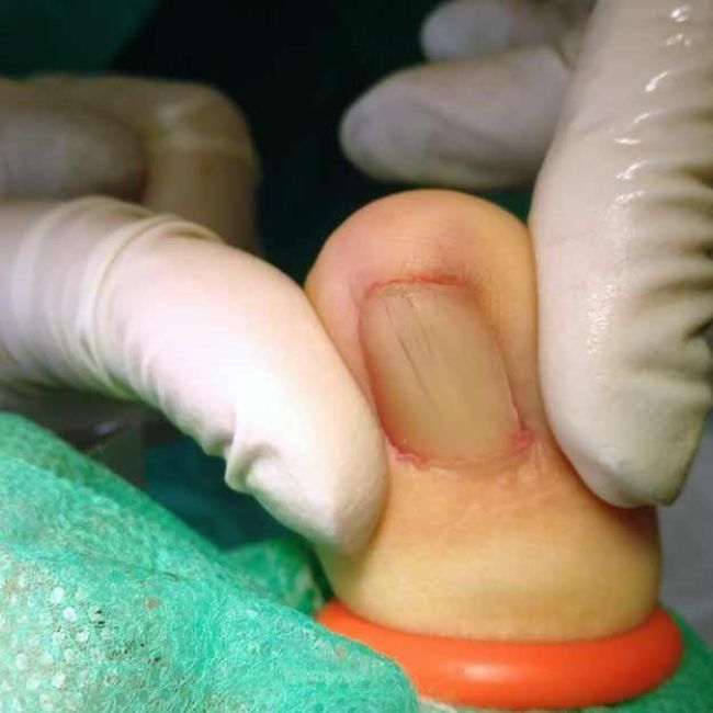 Cirugía de uña encarnada