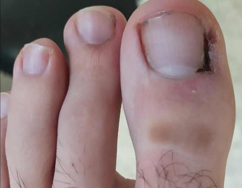 Uñas encarnadas