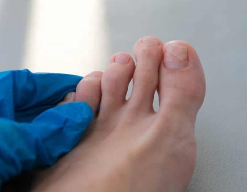Hongos en las uñas Hongos en las uñas