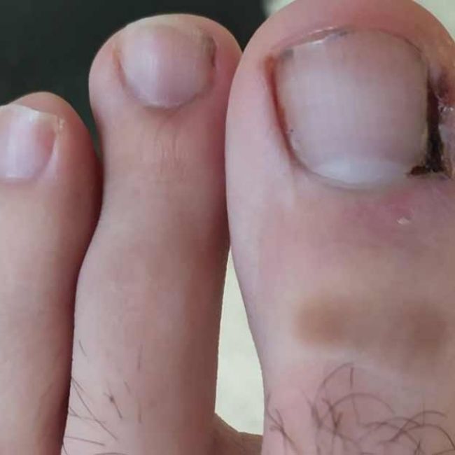 Uñas encarnadas
