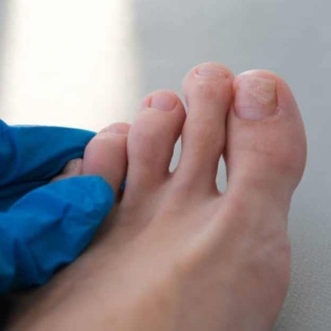 Hongos en las uñas