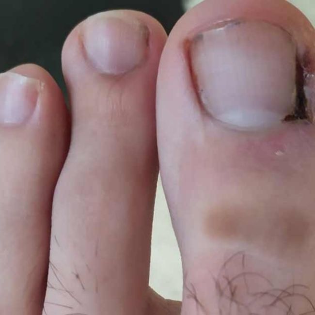 Uñas encarnadas